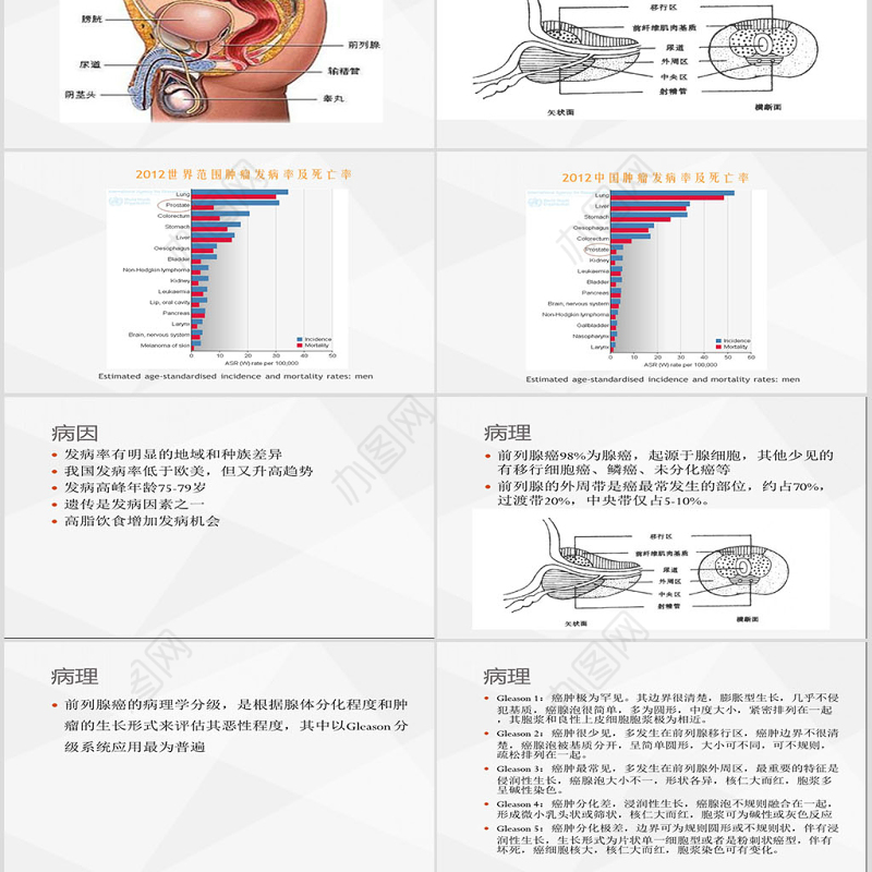 前列腺癌大学课件PPT