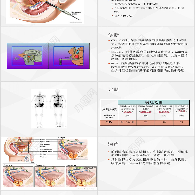 前列腺癌大学课件PPT