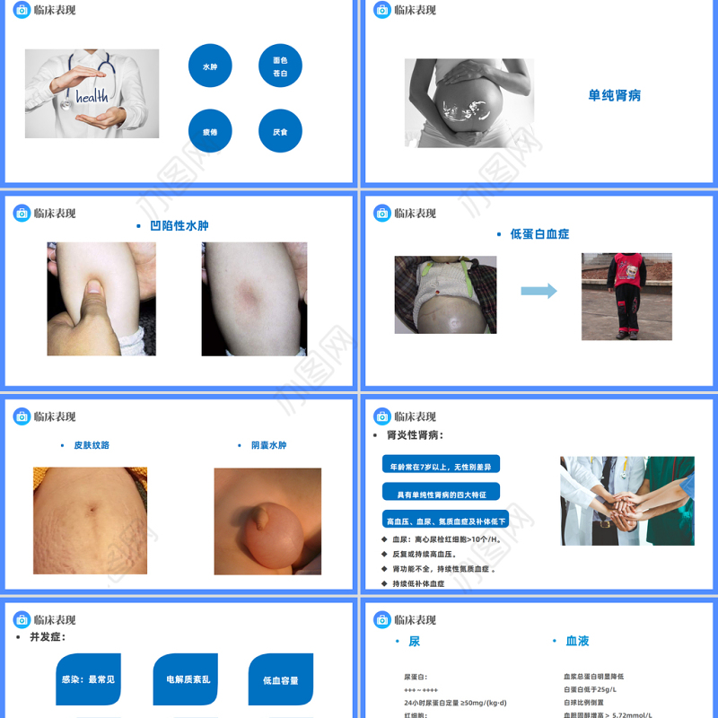 2023原发性肾病综合征PPT简约插画风医疗原发性肾病综合征护理查房课件模板