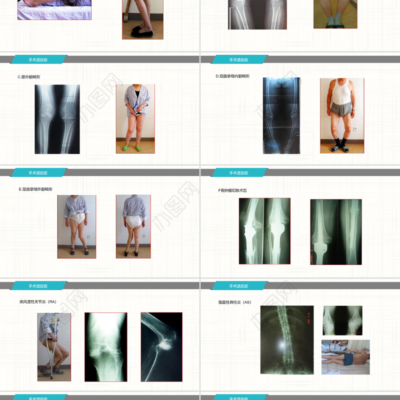 2022膝关节置换术后护理查房PPT商务简约护理查房必备PPT