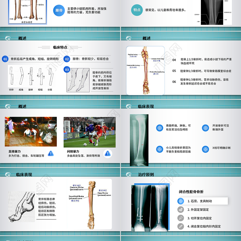 2022胫腓骨骨折护理PPT简约个性医学护理通用PPT