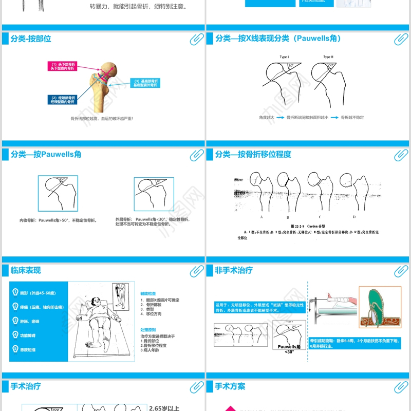 股骨颈骨折护理查房ppt